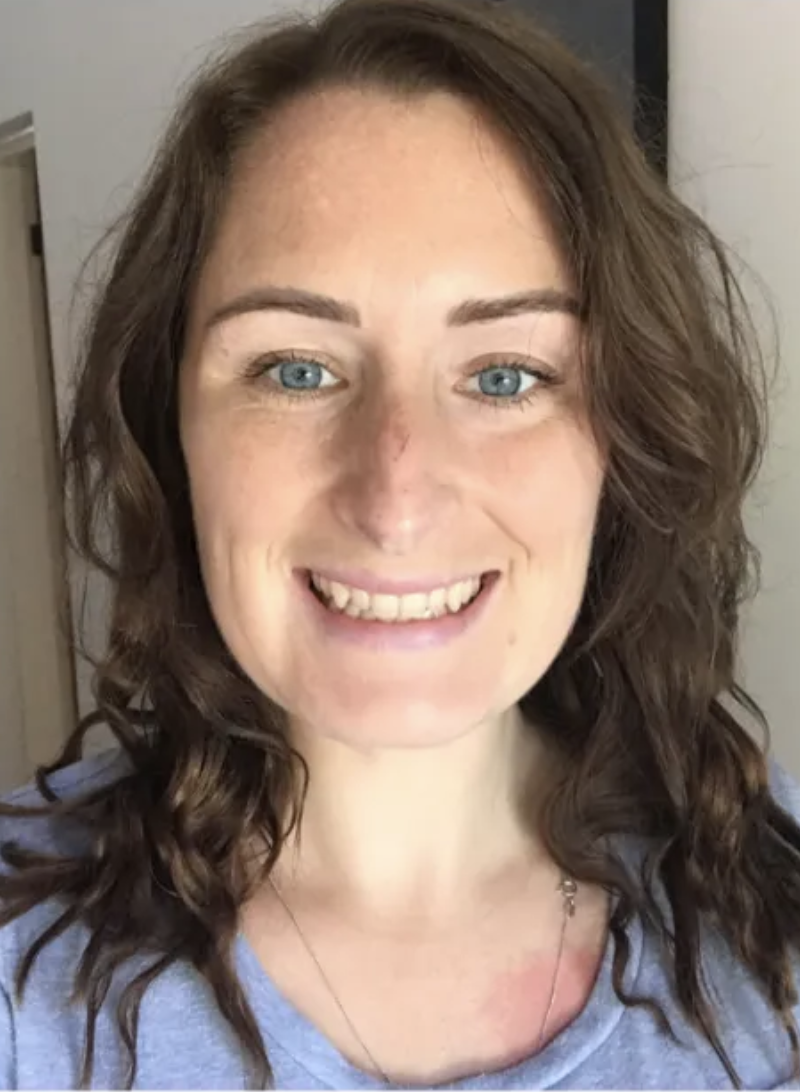 Vestibular Migraines